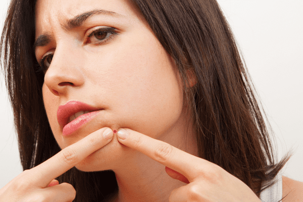 Benzagel-QandA-Popping-Pimples